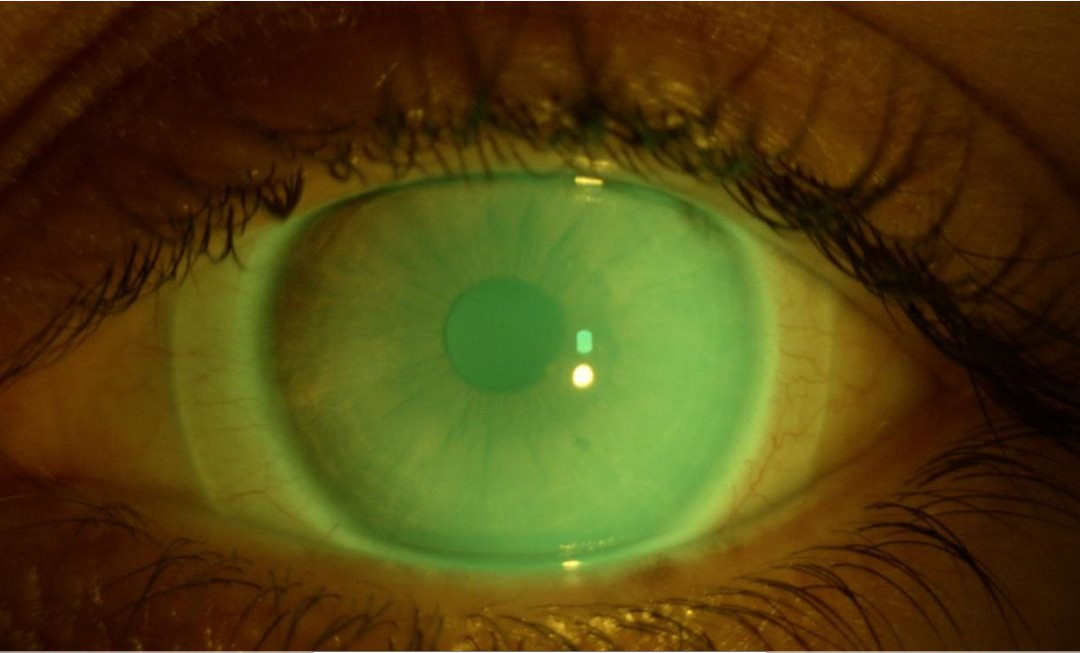 Lenti per cheratocono