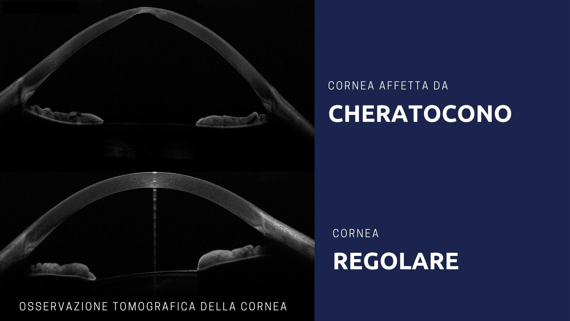 Cheratocono - occhio