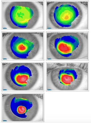 Cheratocono - schema cornea