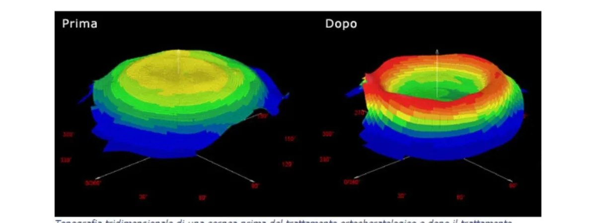 Trattamento Orto-K - risultato