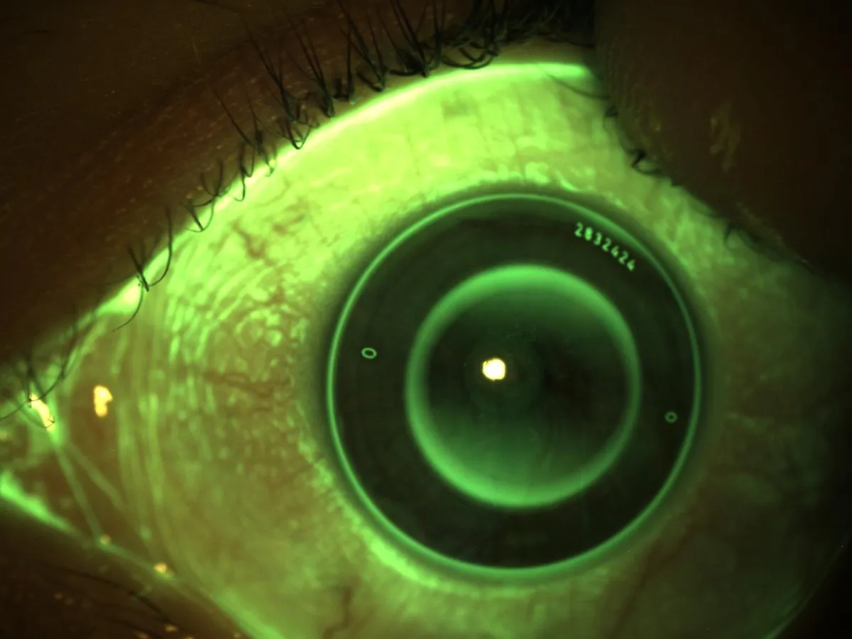 Trattamento Orto-K - risultato