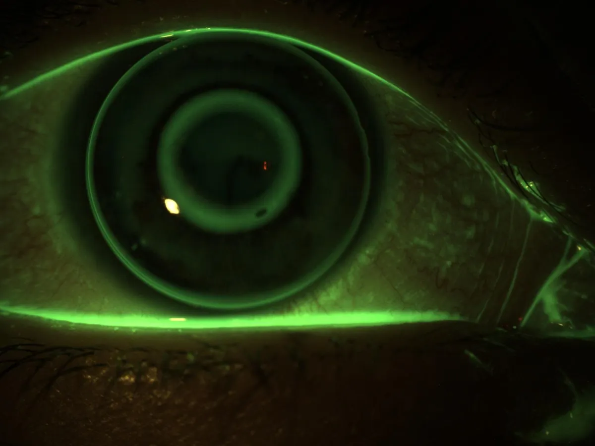 Trattamento Orto-K - risultato