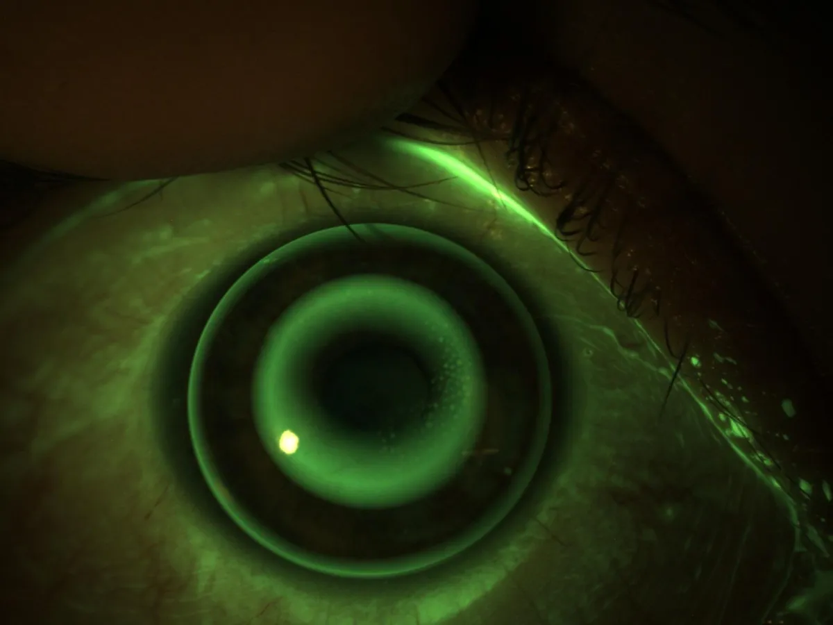 Trattamento Orto-K - risultato