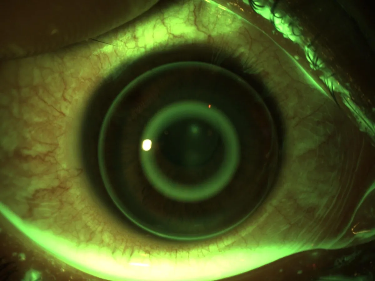 Trattamento Orto-K - risultato