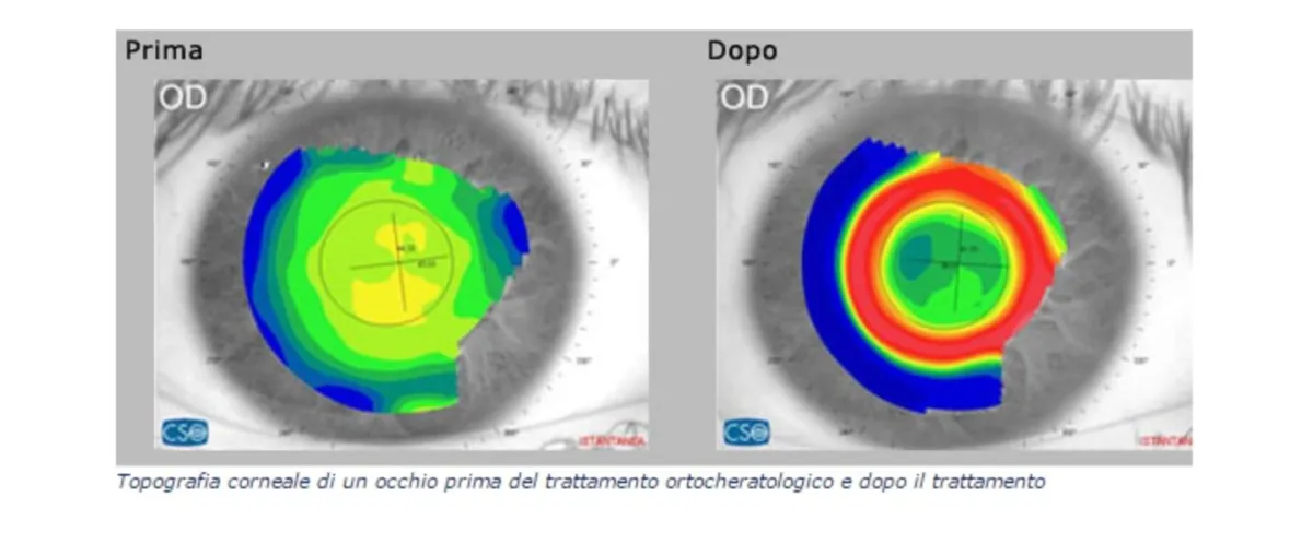 Trattamento Orto-K - risultato